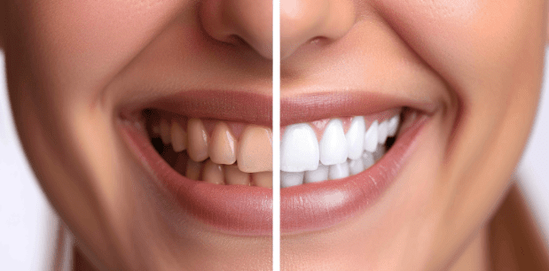 why-choose-antalya-for-teeth-whitening?-benefits,-costs,-and-results